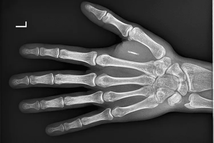 The Future of Microchip Implants in Humans